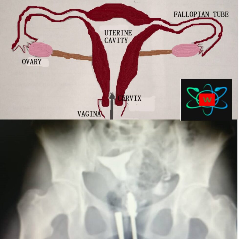 WHAT TO EXPECT AT HYSTEROSALPINGOGRAPHY (HSG) PROCEDURE